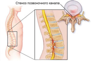 Лечение стеноза позвоночного канала в Израиле