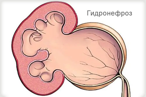 Лечение гидронефроза в Израиле