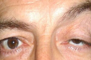 Лечение опущения верхнего века (птоза) в Израиле