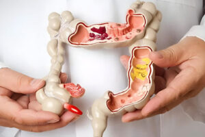 Лечение рака кишечника в Израиле