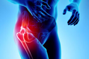 Лечение травмы тазобедренного сустава в Израиле