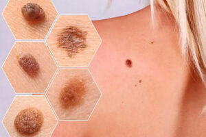 Лечение рака кожи в Израиле