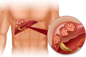 Лечение рака печени в Израиле