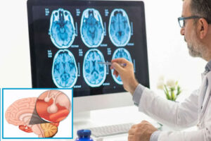 Лечение аденомы гипофиза в Израиле