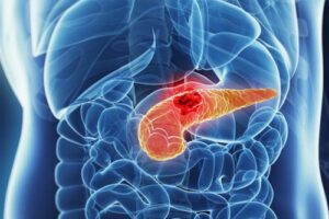Лечение рака поджелудочной железы в Израиле