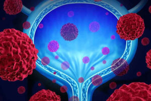 Лечение рака мочевого пузыря в Израиле