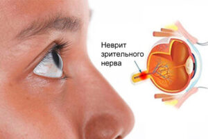 Лечение неврита глазного нерва в Израиле