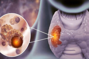 Лечение карциномы щитовидной железы в Израиле