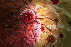 Лечение метастазов в Израиле