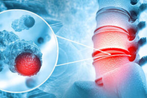 Лечение рака позвоночника в Израиле