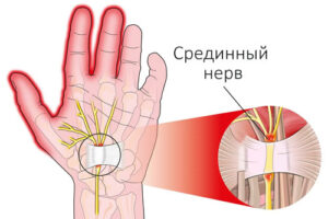 Лечение синдрома запястного канала в Израиле