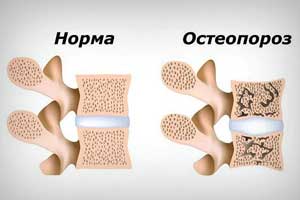 Методики диагностики остеопороза
