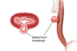 Лечение дивертикула пищевода в Израиле
