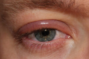 Лечение опухоли век в Израиле