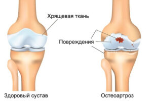 Лечение остеоартроза коленных суставов в Израиле