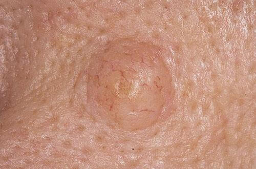 Лечение базалиомы в Израиле. Диагноз и прогноз | Цены и отзывы в Ихилов