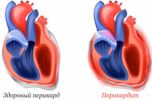 ПЕРИКАРДИТ ᐉ Симптомы • Лечение • Причины • Признаки • Лекарства в Аптеке Низких Цен (АНЦ)
