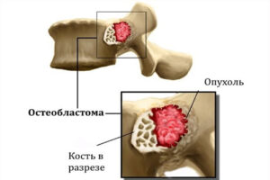остеобластома позвоночника