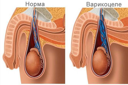 Варикоцеле: действительно ли может вызвать бесплодие | Блог ИКСИ