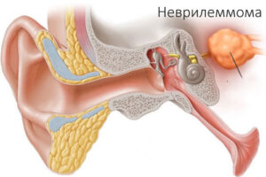 Лечение неврилеммомы в Израиле