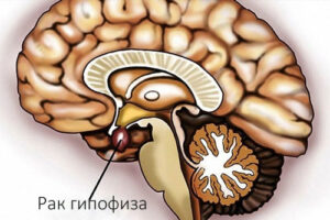 Лечение рака гипофиза в Израиле
