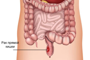 Лечение рака прямой кишки в Израиле