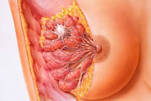 Лечение рака груди в Израиле