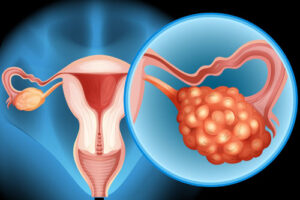 рак яичников