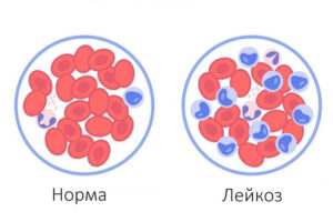 острый лейкоз