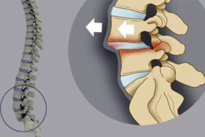 Лечение спондилолистеза у детей в Израиле