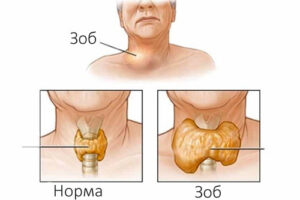 Лечение зоба в Израиле