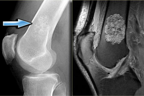 Лечение энхондромы в Израиле | Цены и отзывы в Ихилов