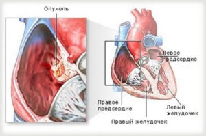 фиброма сердца