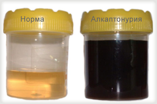 Лечение алкаптонурии в Израиле