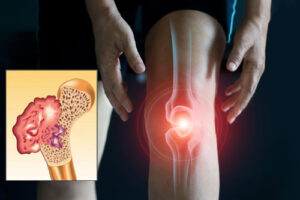 Лечение остеохондромы в Израиле