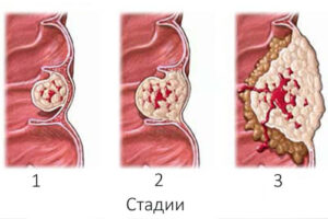 рак толстой кишки