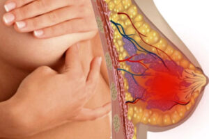 Лечение мастопатии в Израиле