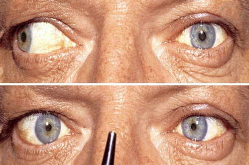 Лечение офтальмоплегии в Израиле