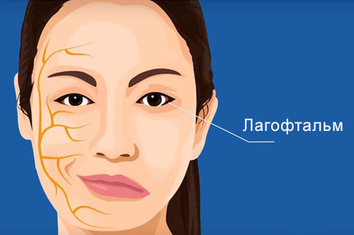 Лечение лагофтальма в Израиле