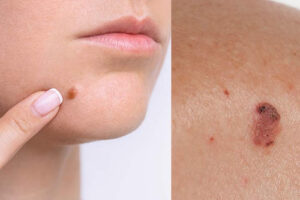 Лечение саркомы кожи в Израиле