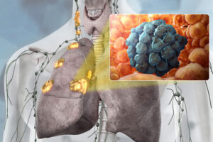 Лечение лимфомы легкого в Израиле