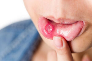 лечение рака слизистой оболочки рта в Израиле