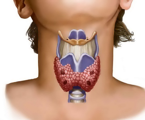 Узлы щитовидной железы: мифы и реальные опасности