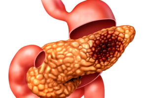 Новый анализ меняет подход к скринингу рака поджелудочной железы